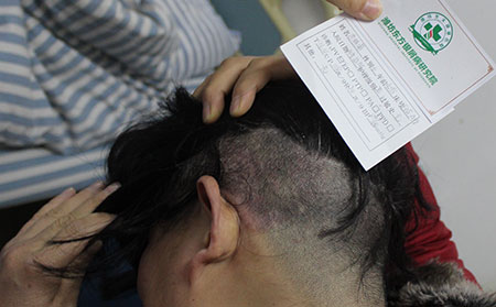 濰坊東方銀屑病研究院治療費用