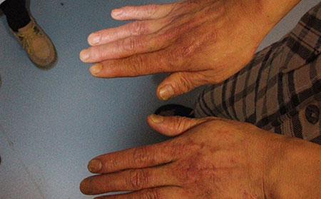 銀屑病患者仲春的護理