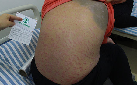 銀屑病復發的常見原因