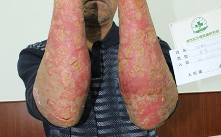 大片的牛皮癬鱗屑脫落的治療