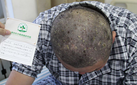 銀屑病過度治療的誤區