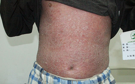 銀屑病治療期間的護理