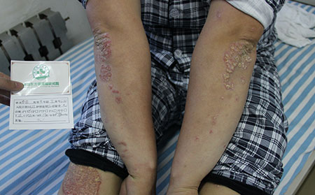 口腔潰瘍會導致銀屑病嗎