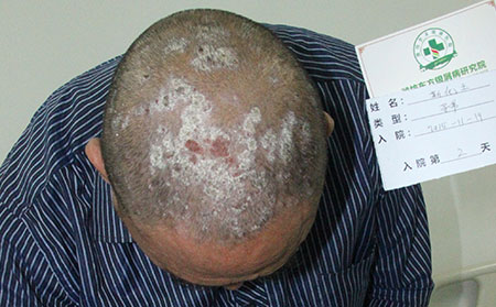 銀屑病去哪里治滿意