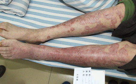 感冒導致的銀屑病如何治