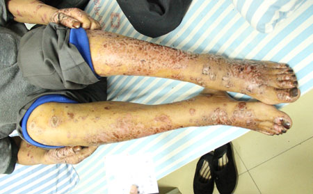 如何降低藥物對銀屑病患者的生育影響