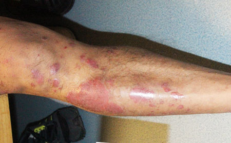 如何治療銀屑病不容易復發