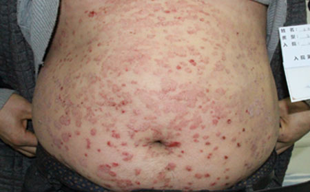 面部銀屑病加重的原因