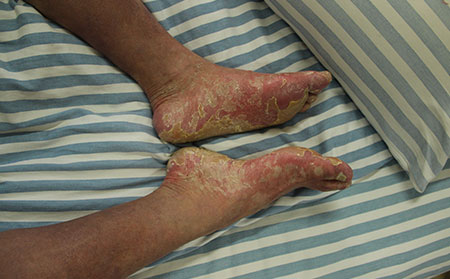 銀屑病病情不穩的原因