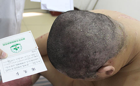 頭部牛皮癬要如何治療