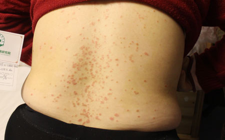 夏季對銀屑病不利的因素