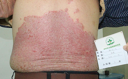 尋常性銀屑病和紅皮型銀屑病的不同