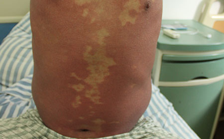 銀屑病治療不能盲目圖快