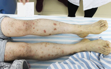 銀屑病患者排毒方法