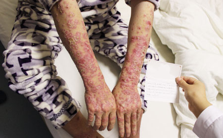 中醫治療銀屑病