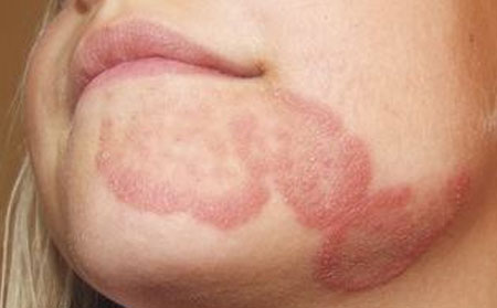 夏季銀屑病治療陷阱