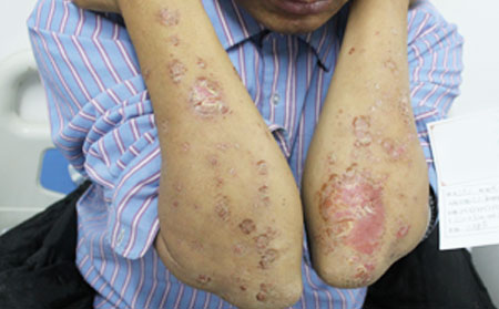 銀屑病治療方法