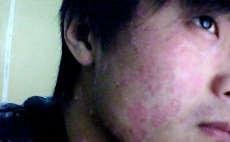 銀屑病治療誤區(qū)