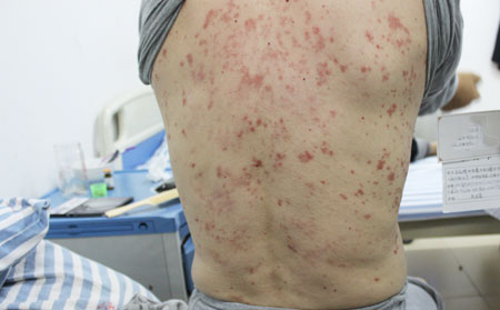 銀屑病早期癥狀