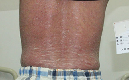 夏季輔助治療銀屑病的方法