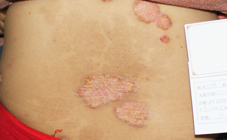 銀屑病治療費用