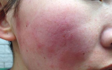 夏季治療銀屑病的可以處