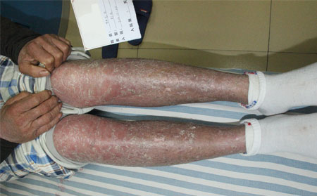 夏季治療銀屑病