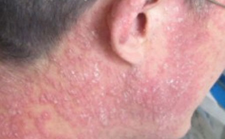 有效治療銀屑病