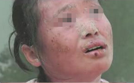 中醫治療銀屑病