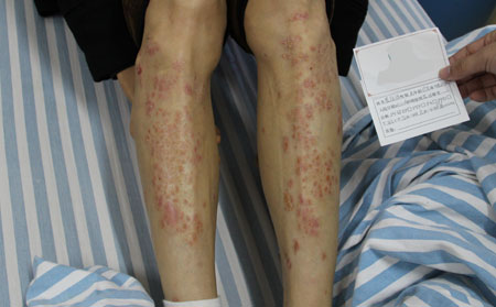 銀屑病皮損恢復