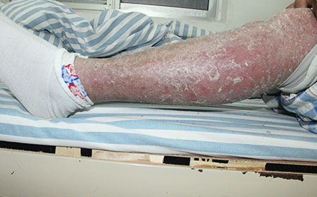 銀屑病是什么原因引起的