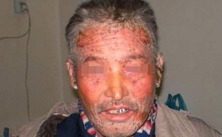 銀屑病復發原因