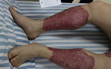 如何診斷關(guān)節(jié)型銀屑病