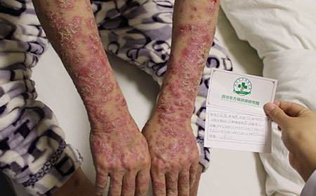 中老年關(guān)節(jié)型銀屑病能好的嗎