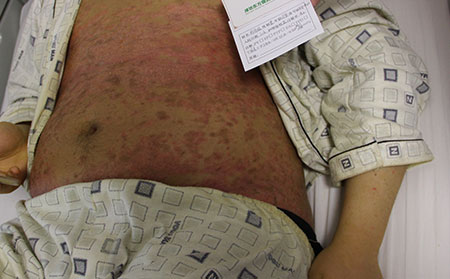 濰坊東方銀屑病研究院專業治療