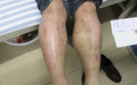 尋常型銀屑病癥狀