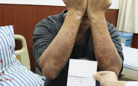 銀屑病治療誤區介紹