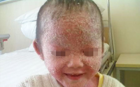 銀屑病治療專業(yè)醫(yī)院