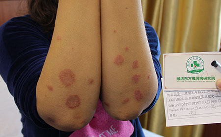 引發(fā)牛皮癬的因素