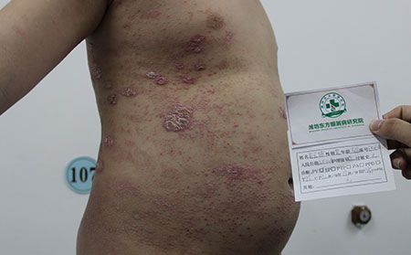 銀屑病治療不規范方法