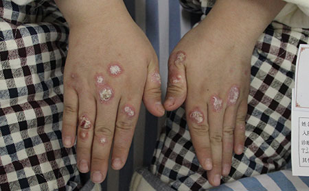 銀屑病用藥護理