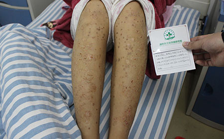 銀屑病的環境因素