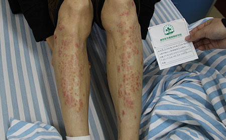 老年人關節型銀屑病