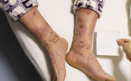 濰坊銀屑病治療費用