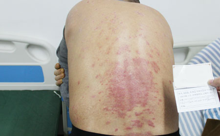 銀屑病復發原因