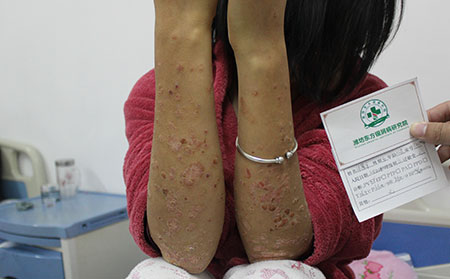 銀屑病夏季治療方法