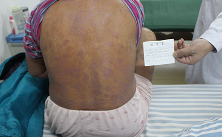 治牛皮癬較好的醫院