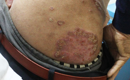 銀屑病夏季加重原因