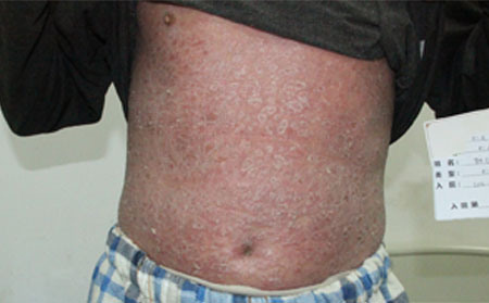 銀屑病治療原則