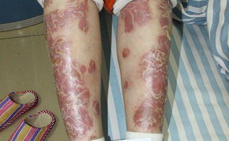 銀屑病夏季護理